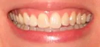 After Cosmetic Tooth Bleaching