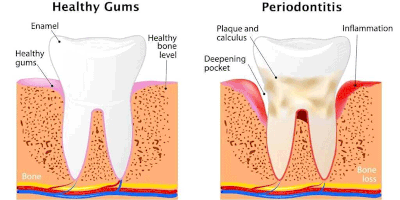 Gum Disease Specialists