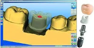 Cerec Abutment