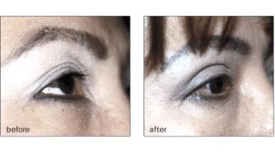 Before & After Of Eyelid Brow Lift 