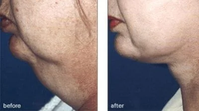 Before & After Of Neck Lift