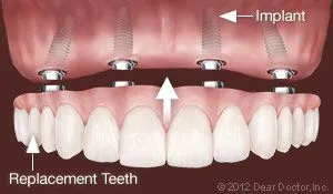 Illustration of dental implants as a snap-on smile in Honolulu, HI