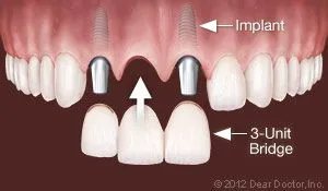 Illustration of dental implant as dental bridge in Honolulu, HI