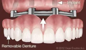 Illustration of dental implants with removable dentures attachment in Honolulu, HI