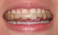 Hard mouthguard in patient's mouth