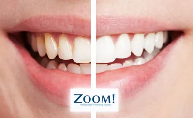 zoom whitening