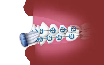 Brushing while Wearing Braces