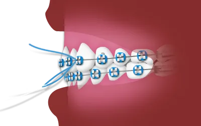 Flossing while Wearing Braces