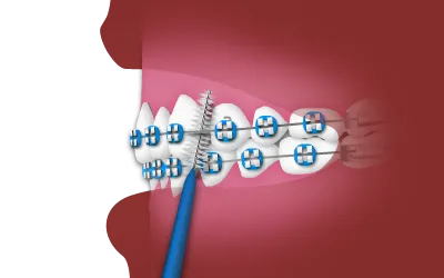 Using an Interdental Toothbrush