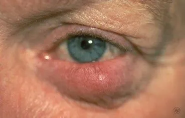 rosacea_symptoms-ocular.jpg