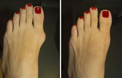 bunion surgery