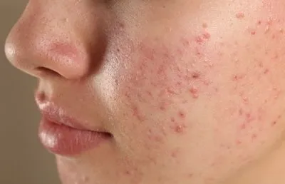 Illustration of acne on skin