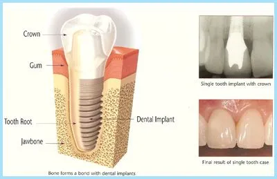 Dental Implants 07728