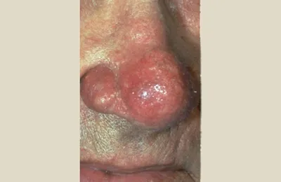 rosacea_symptoms_rhynophyma.jpg