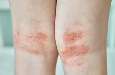 Close-up of eczema rash in child’s knee fold