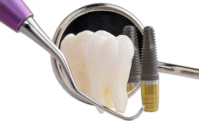 Dental Implant La Mesa