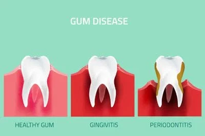 Periodontal Gum Disease 