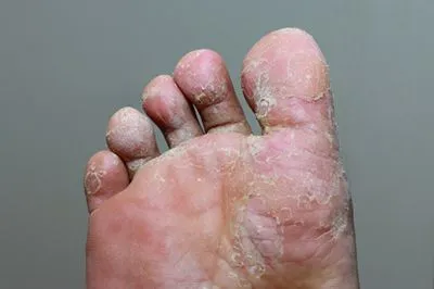 Illustration of Athlete’s Foot