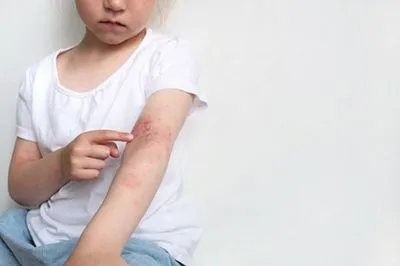 Young-girl-suffering-in-rashes-in-red