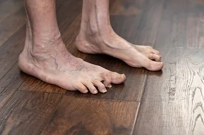 Illustration of hammertoes on a person