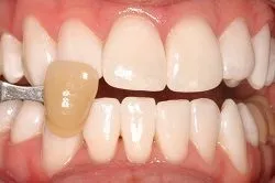 Teeth Whitening After