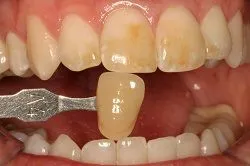 Teeth Whitening Before