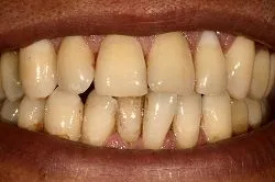 Before Teeth Whitening