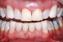 After Teeth Whitening