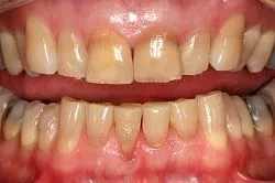 Before Teeth Whitening