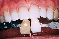 After Teeth Whitening