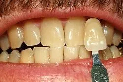 Before Teeth Whitening