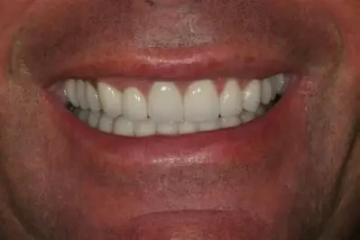 Porcelain Veeners After