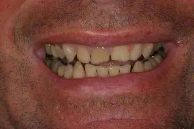 Porcelain Veneers Before