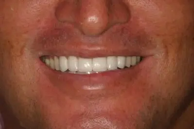 Porcelein Veneers After