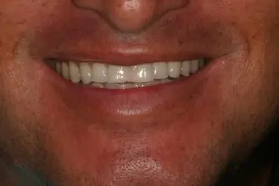 Porcelein Veneers Before