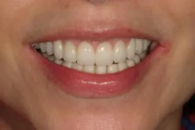Porcelein Veneers After