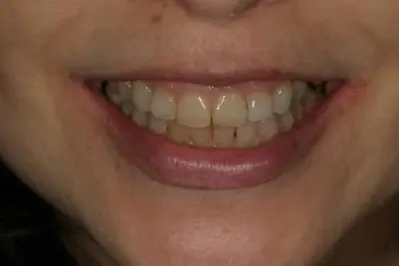 Porcelein Veneers Before