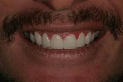Porcelein Veneers After
