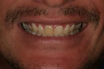 Porcelein Veneers Before