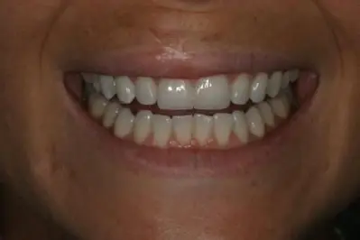 Porcelein Veneers After