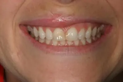 Porcelein Veneers Before