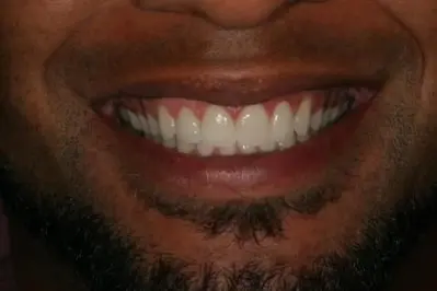 Porcelein Veneers After