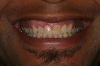 Porcelein Veneers Before