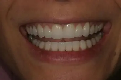 Porcelein Veneers After