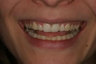 Porcelein Veneers Before