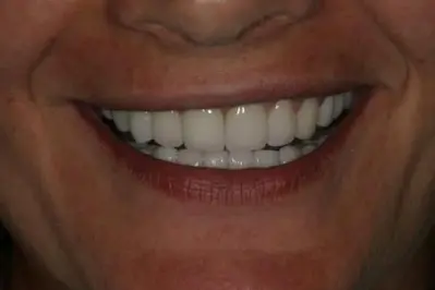 Porcelein Veneers After