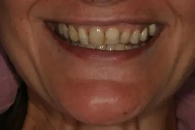 Porcelein Veneers Before