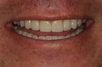 Porcelain Crowns After