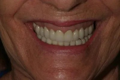 Porcelain Crowns After