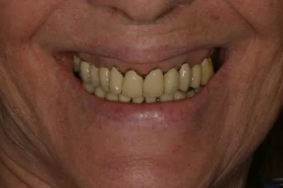 Porcelain Crowns Before